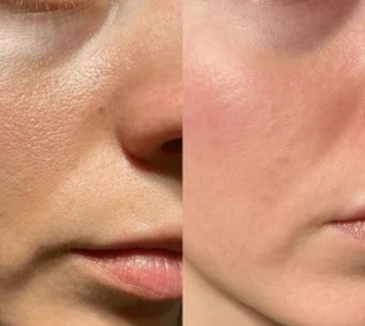 PureVacc Facial Pore Vaccum