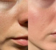 PureVacc Facial Pore Vaccum