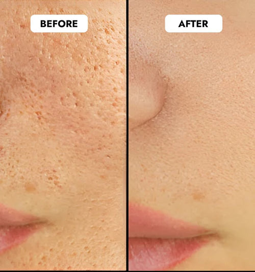 PureVacc Facial Pore Vaccum