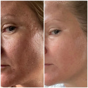 PureVacc Facial Pore Vaccum